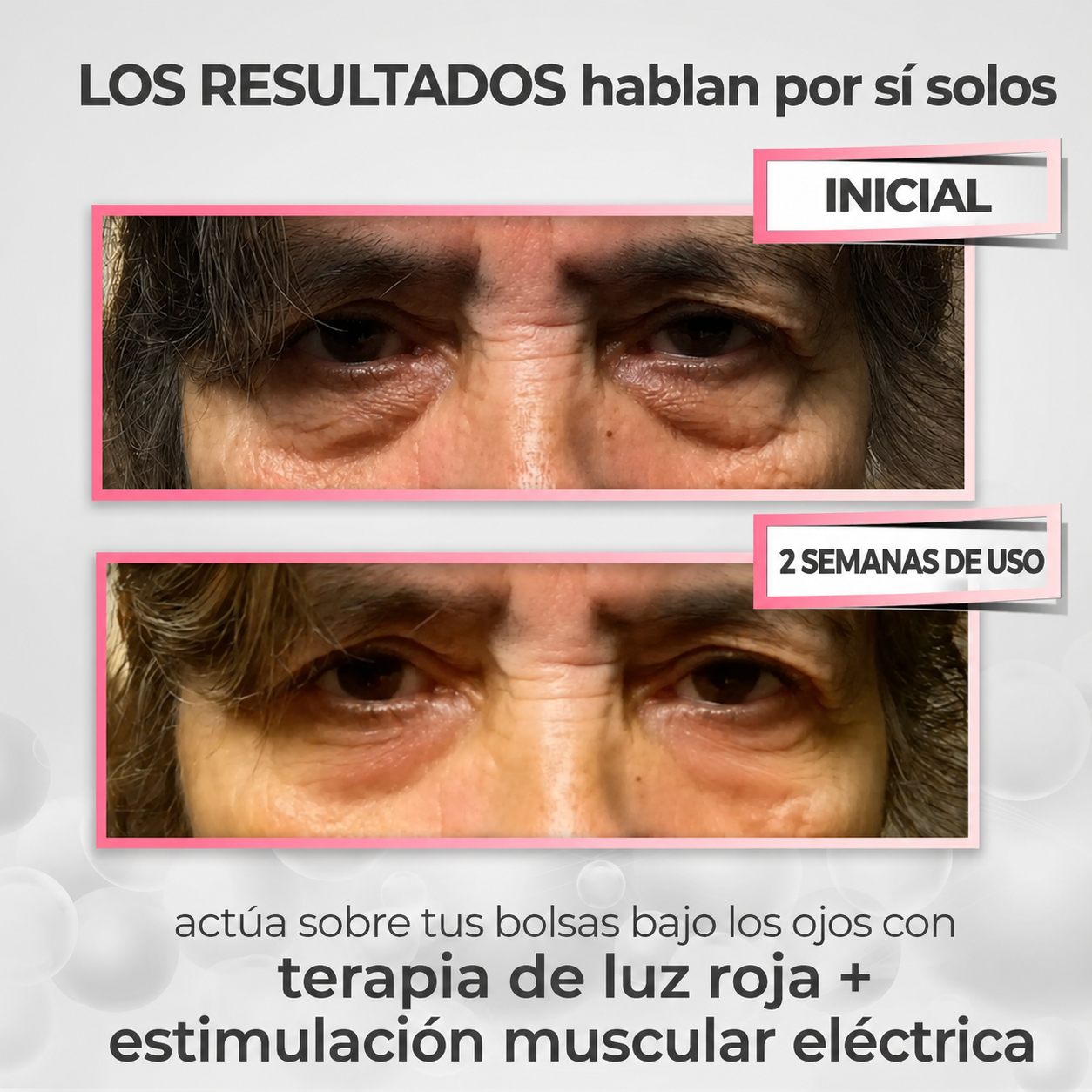 Reductor de Ojeras y Bolsas – Luz Roja y Microcorriente