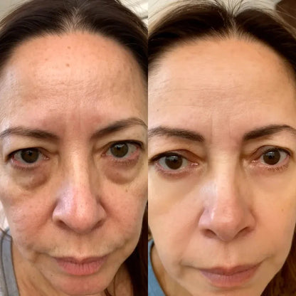 Reductor de Ojeras y Bolsas – Luz Roja y Microcorriente