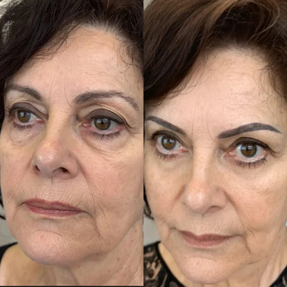 Reductor de Ojeras y Bolsas – Luz Roja y Microcorriente